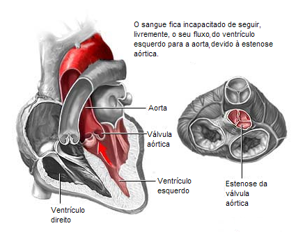 Атеросклероз аорты с поражением аортального клапана - Подборка